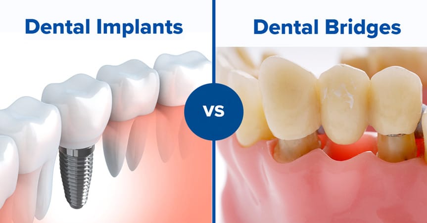 Comparison of a dental implant and dental bridge for replacing a missing tooth
