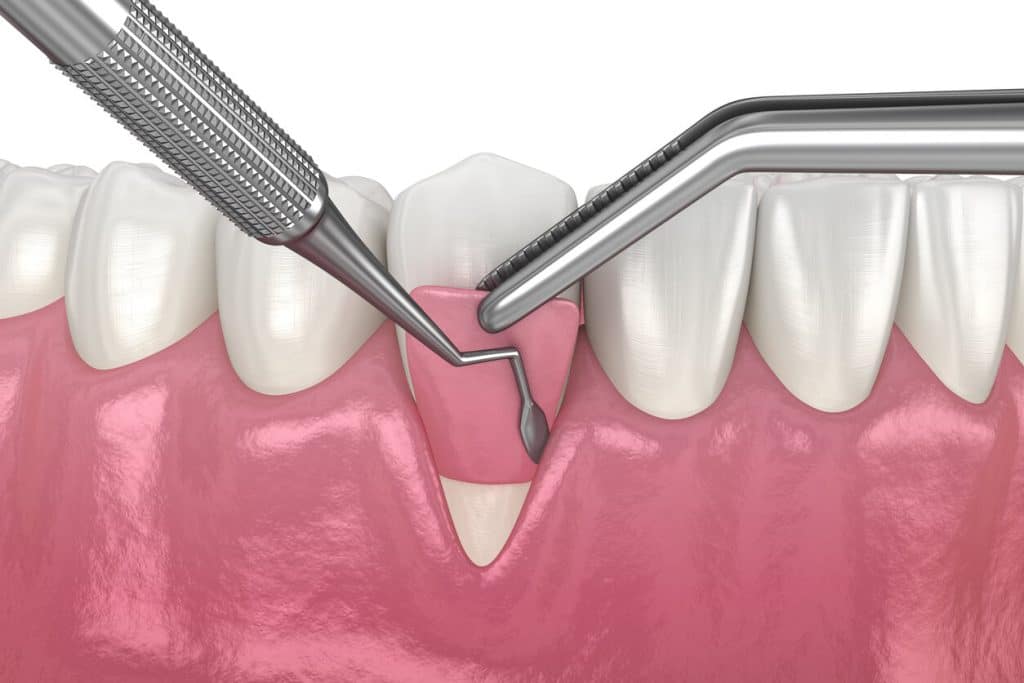 Dental instruments performing a gum grafting procedure on a receding gumline