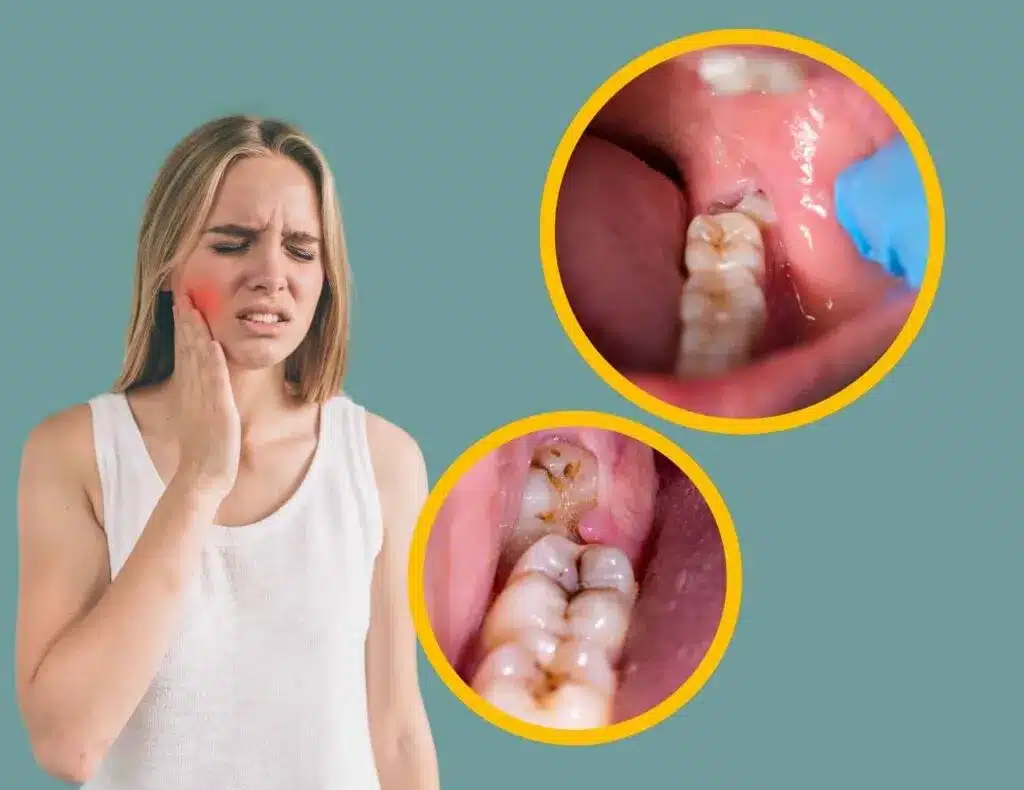 Woman experiencing wisdom tooth pain with close-up views of problematic wisdom teeth